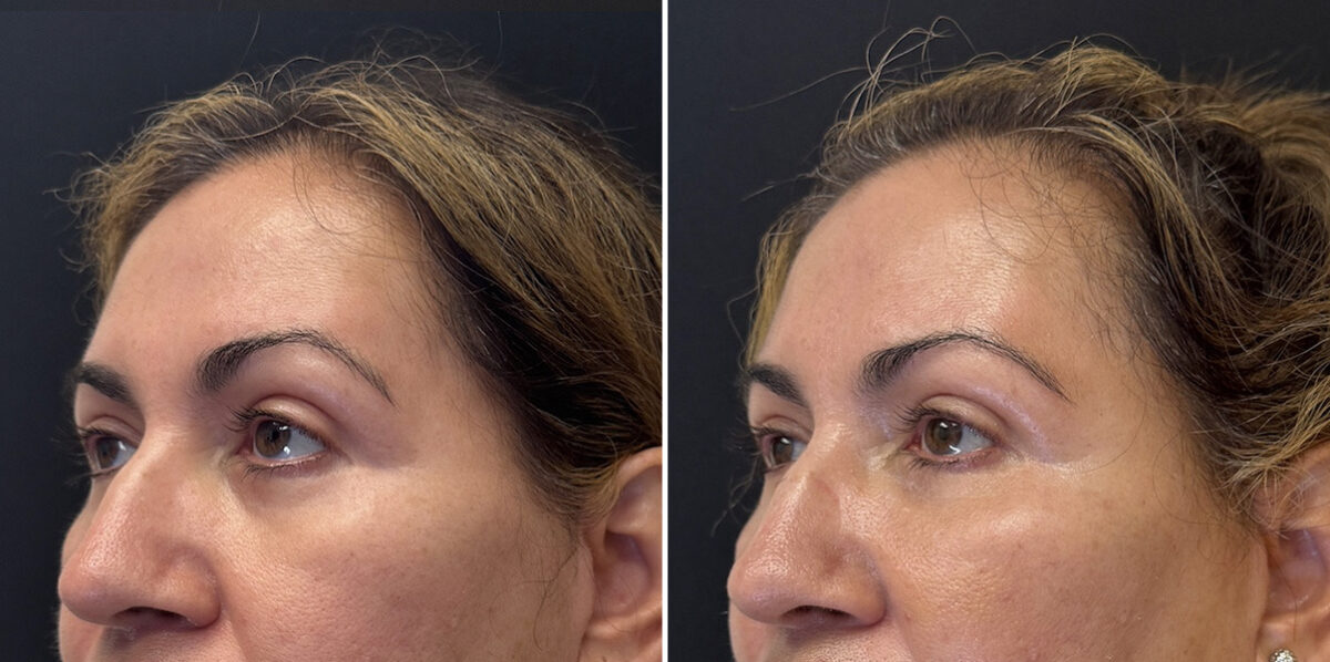 Fat Transfer Before and After Photos in CA, Irvine, Patient 5959