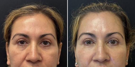 Fat Transfer Before and After Photos in CA, Irvine, Patient 5959