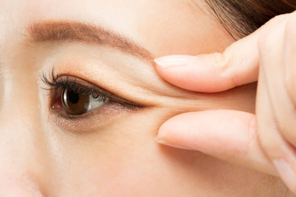 Close-up of an upper eyelid showing skin lift to illustrate double eyelid surgery candidates with excess skin or low crease.