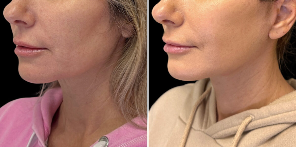 Facelift & Necklift Before and After Photos in CA, Irvine, Patient 5975