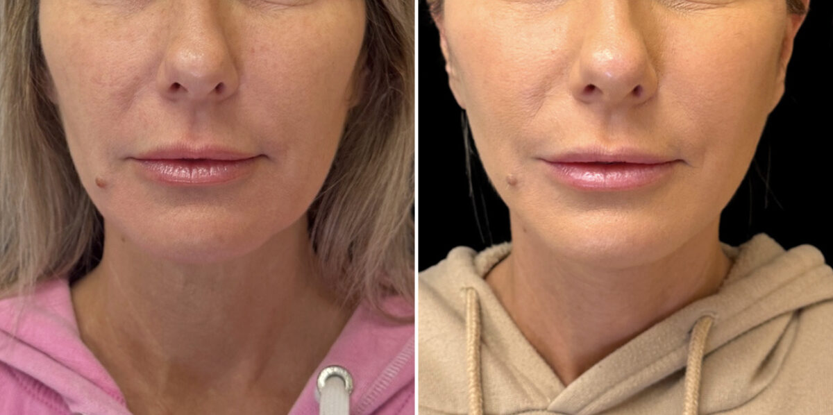 Facelift & Necklift Before and After Photos in CA, Irvine, Patient 5975