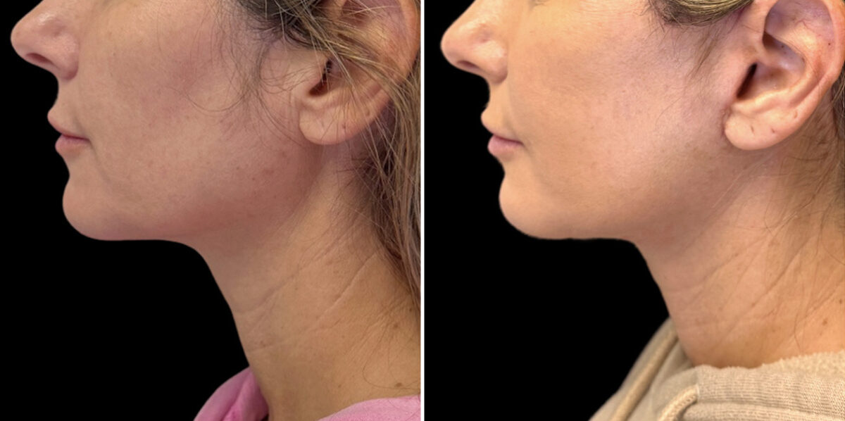 Facelift & Necklift Before and After Photos in CA, Irvine, Patient 5975