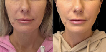 Facelift & Necklift Before and After Photos in CA, Irvine, Patient 5975