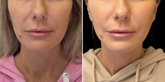 Facelift & Necklift Before and After Photos in CA, Irvine, Patient 5975