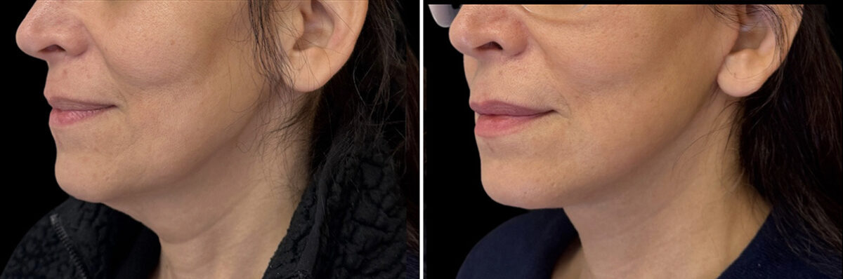 Facelift & Necklift Before and After Photos in CA, Irvine, Patient 6013