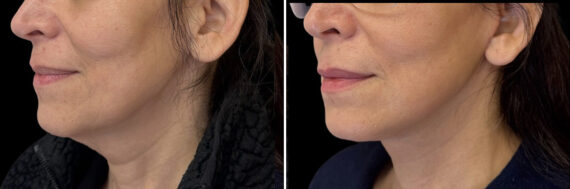 Facelift & Necklift Before and After Photos in CA, Irvine, Patient 6013