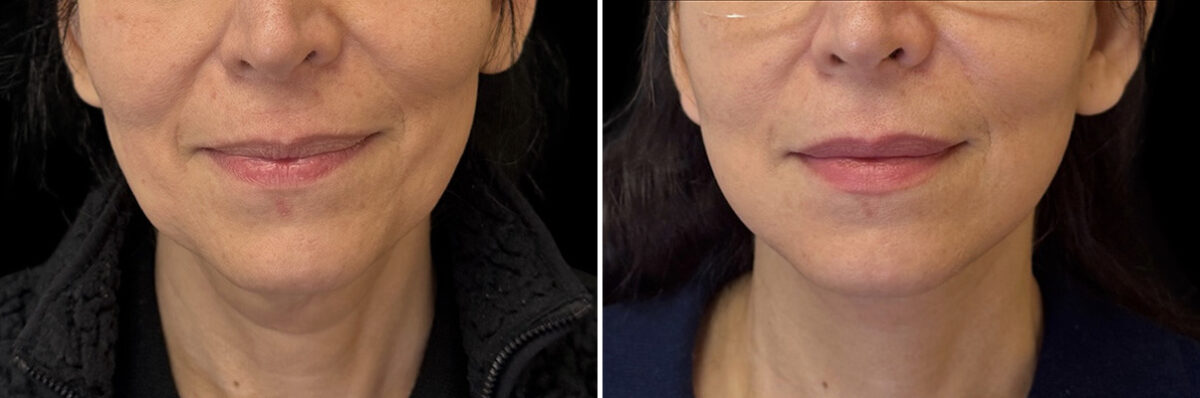 Facelift & Necklift Before and After Photos in CA, Irvine, Patient 6013