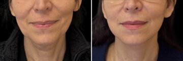 Facelift & Necklift Before and After Photos in CA, Irvine, Patient 6013