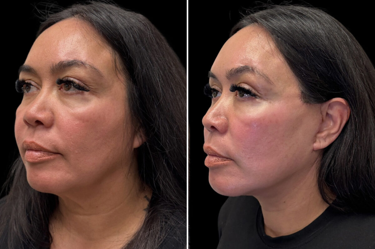 Facelift & Necklift Before and After Photos in CA, Irvine, Patient 6016