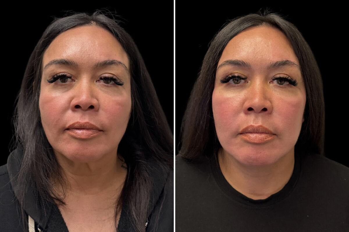Facelift & Necklift Before and After Photos in CA, Irvine, Patient 6016