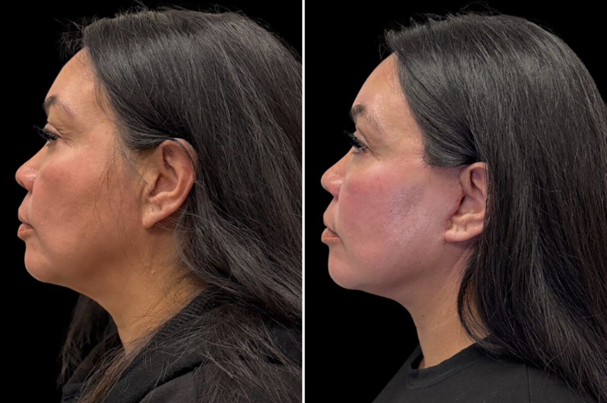 Facelift & Necklift Before and After Photos in CA, Irvine, Patient 6016