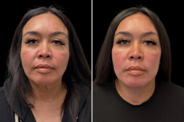 Facelift & Necklift Before and After Photos in CA, Irvine, Patient 6016
