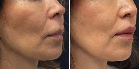 Lip Lift Before and After Photos in CA, Irvine, Patient 6020