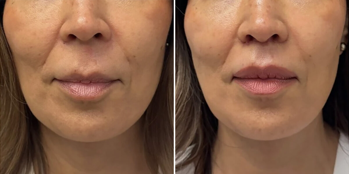 Lip Lift Before and After Photos in CA, Irvine, Patient 6020