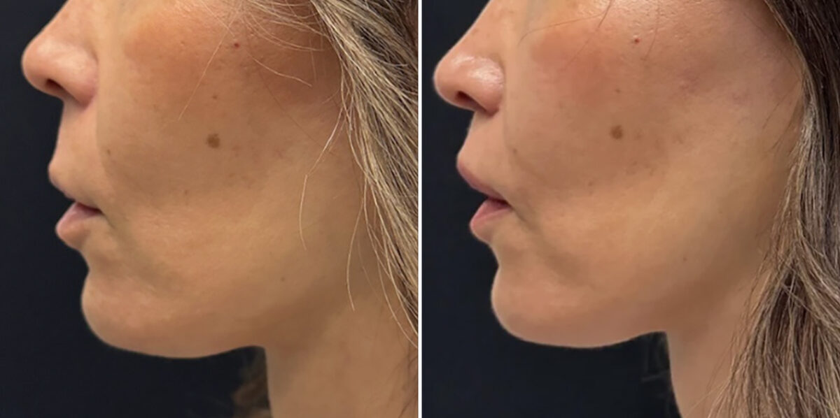 Lip Lift Before and After Photos in CA, Irvine, Patient 6020