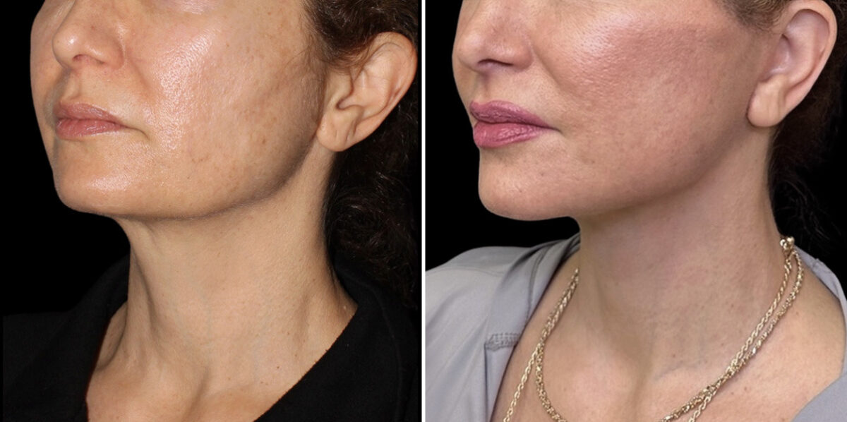 Facelift & Necklift Before and After Photos in CA, Irvine, Patient 6024