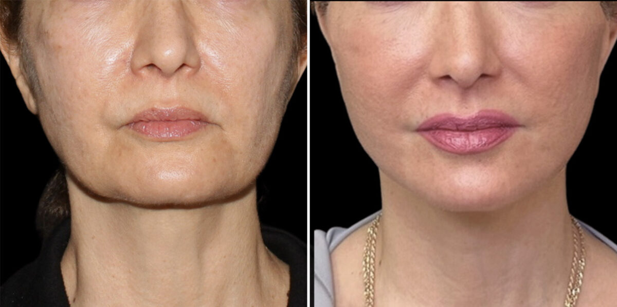 Facelift & Necklift Before and After Photos in CA, Irvine, Patient 6024