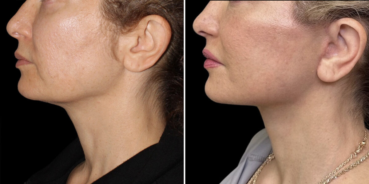 Facelift & Necklift Before and After Photos in CA, Irvine, Patient 6024