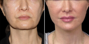 Facelift & Necklift Before and After Photos in CA, Irvine, Patient 6024