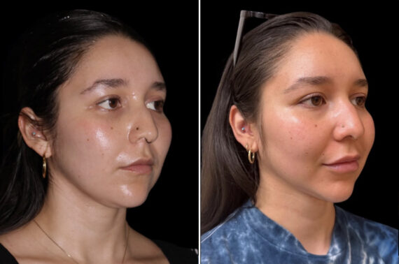 Double Chin Lipo Before and After Photos in CA, Irvine, Patient 6028