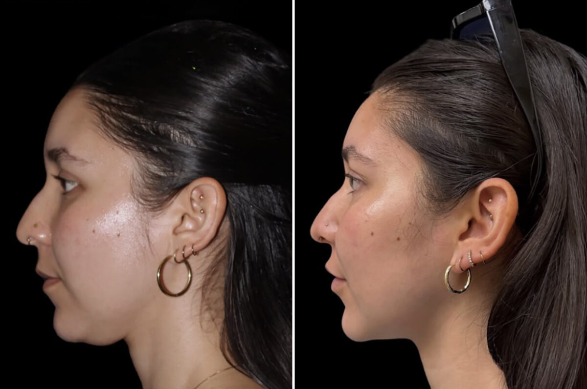Double Chin Lipo Before and After Photos in CA, Irvine, Patient 6028