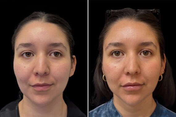 Double Chin Lipo Before and After Photos in CA, Irvine, Patient 6028